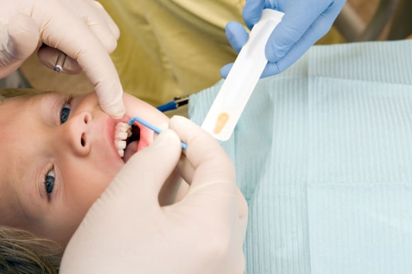 Silver Diamine Fluoride The filling procedure of a little girl's tooth